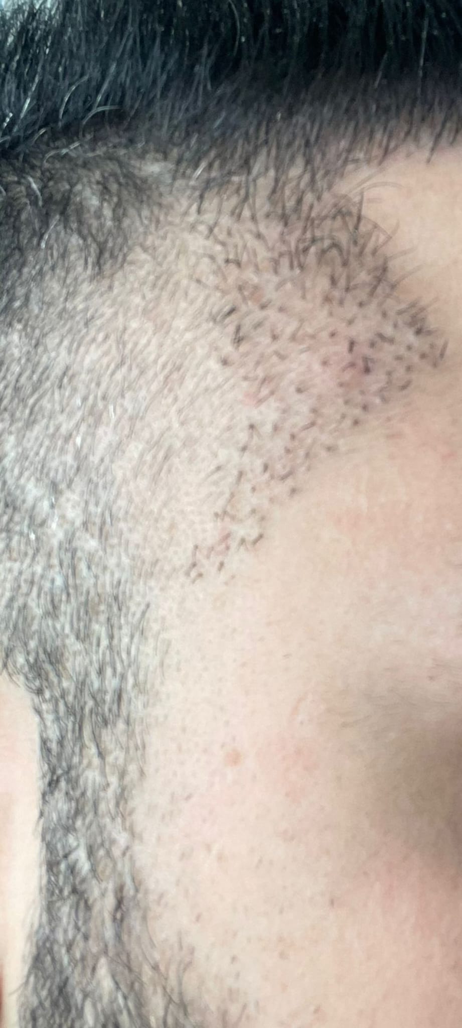 Engin Sönmez Hair Transplant Reviews